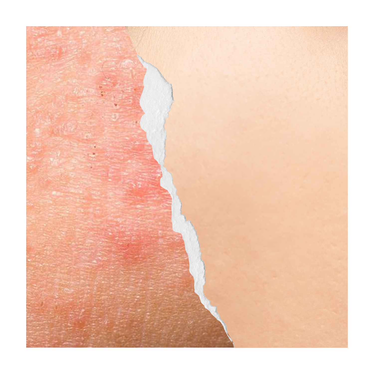 Apaiser la Couperose avec des Soins de Peau Naturels